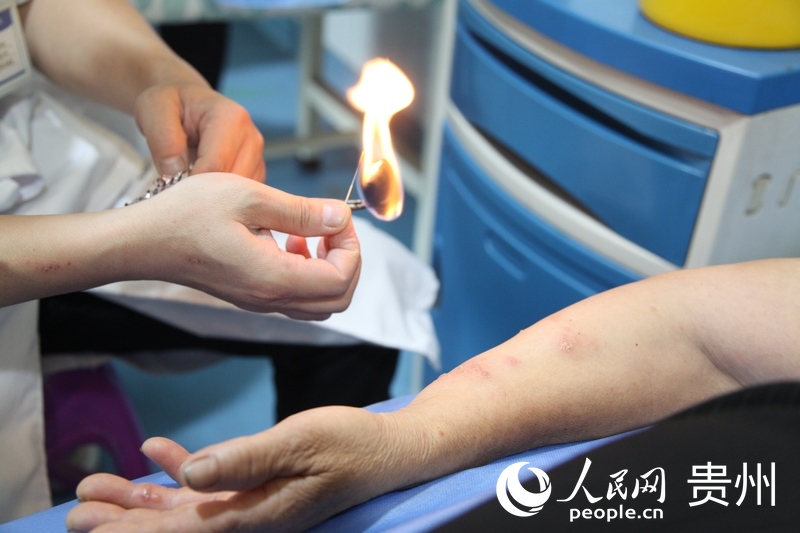 程明慶用火療法為患者治療帶狀皰疹。人民網記者 王秀芳攝