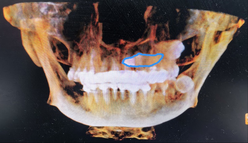 術前：尖牙橫行貫穿埋伏于左上頜骨內，牙冠位于上腭，牙根位于鼻根側下方。
